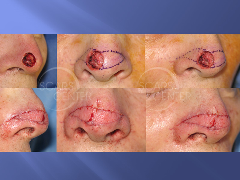 SCARS-Center-Reconstructive-Cases-Bilateral-Nasal-Island-Flaps-for-Large-Nasal-Defects-skin-cancer-nose-8