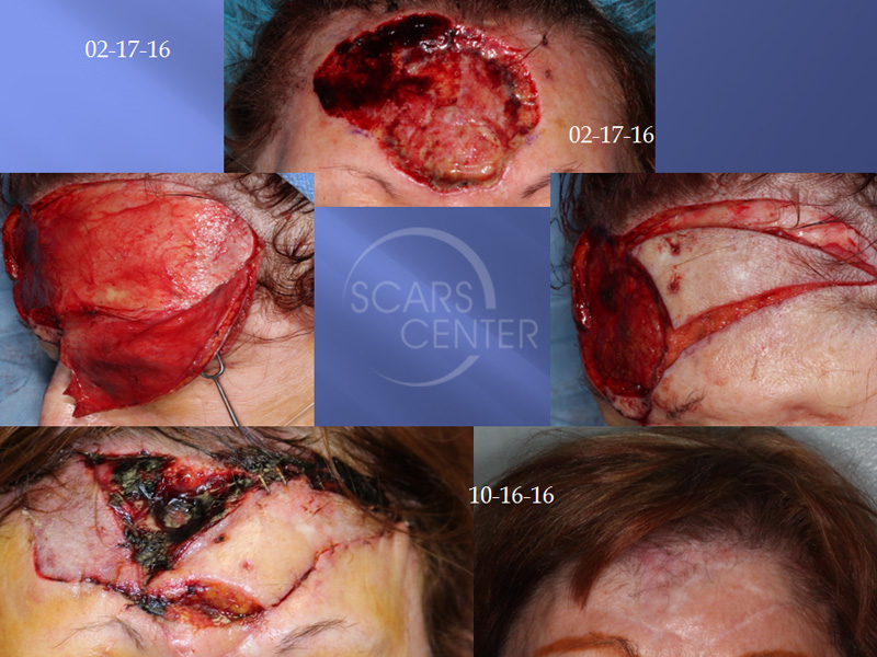 SCARS-Center-Reconstructive-Cases-Large-Forehead-Defects-Skin-cancer-forehead-1.2