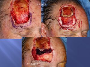 Recurrent Extensive Basal Cell Carcinoma Of Forehead Skin Cancer And Reconstructive Surgery Center