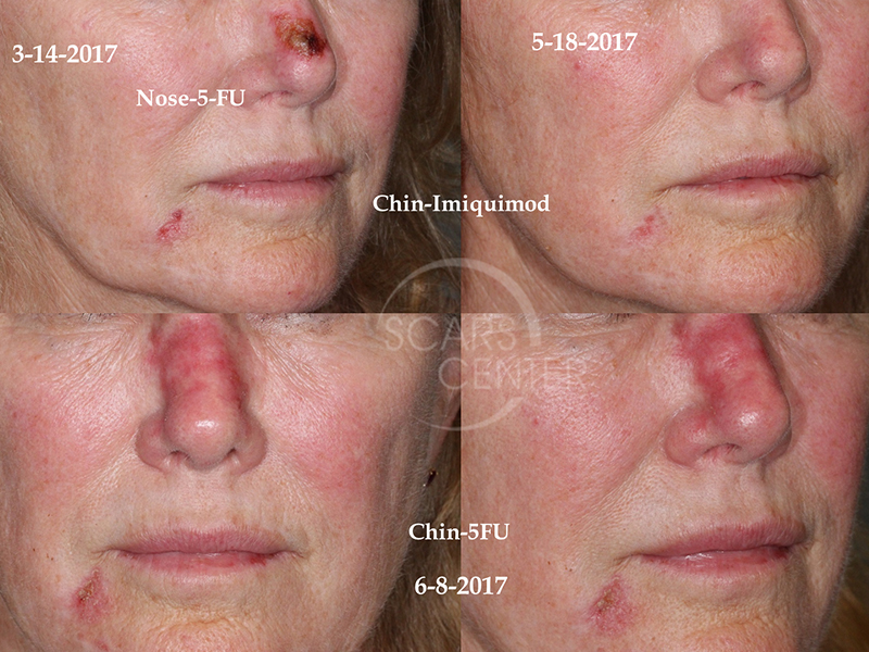 SCARS-Center-topical-5-fluorouracil-efficacy-in-basal-cell-carcinoma-skin-cancer1