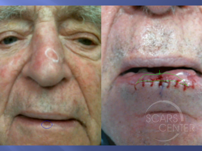 SCC-with-Atypia-SCARS-Center-Case-4-Skin-Cancer-And-Reconstructive-Surgery-Center-Orange-County2
