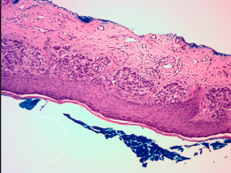 icd 10 code for basal cell carcinoma left ear