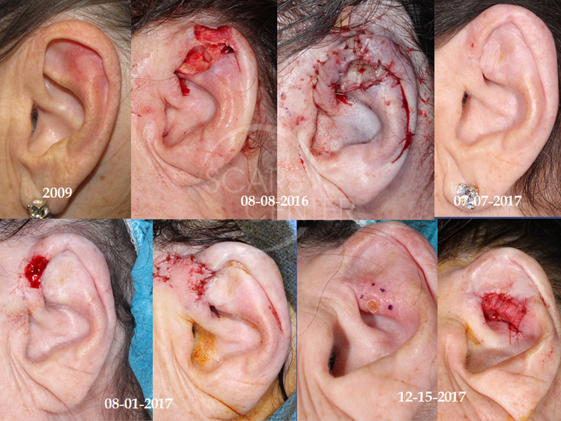 Skin-Cancer-And-Reconstructive-Surgery-Center-Foundation-Left-Ear-Multiply-Recurrent-Basal-Cell-Carcinoma