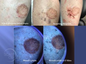 Skin-Cancer-And-Reconstructive-Surgery-Center-Foundation-Mapping-of-Recurrent-Melanoma-In-Situ-of-Leg