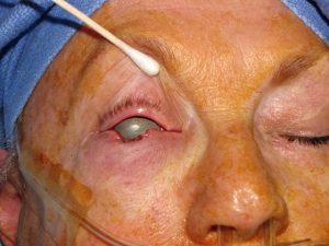 Lower Eyelid Reconstruction Treatment