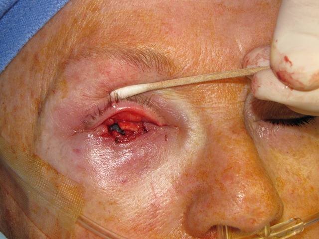 Eyelid Reconstruction Treatment at Scars Center