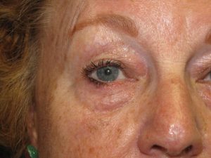 Lower Eyelid Reconstruction Treatment at Scars Center