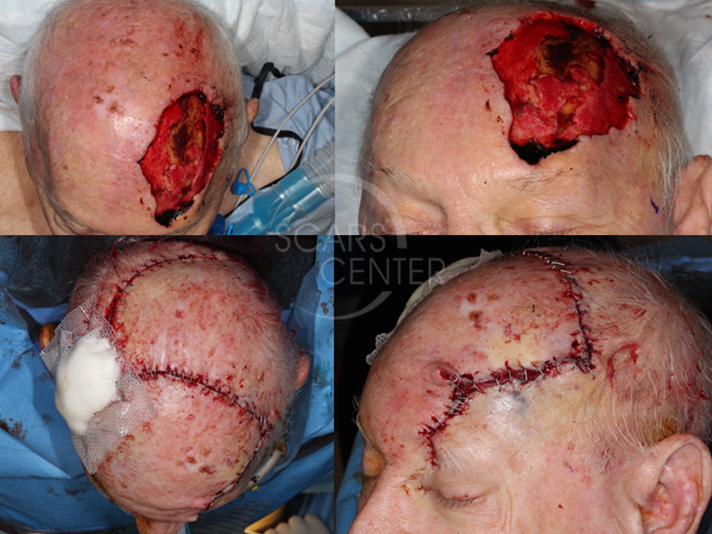Undifferentiated-Pleomorphic-Sarcoma-of-Scalp-Skin-Cancer-And-Reconstructive-Surgery-Foundation2