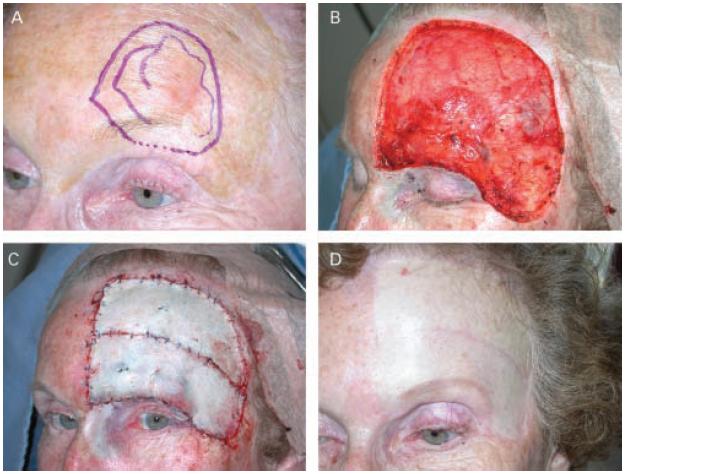 Radical Excision of Melanoma in Situ