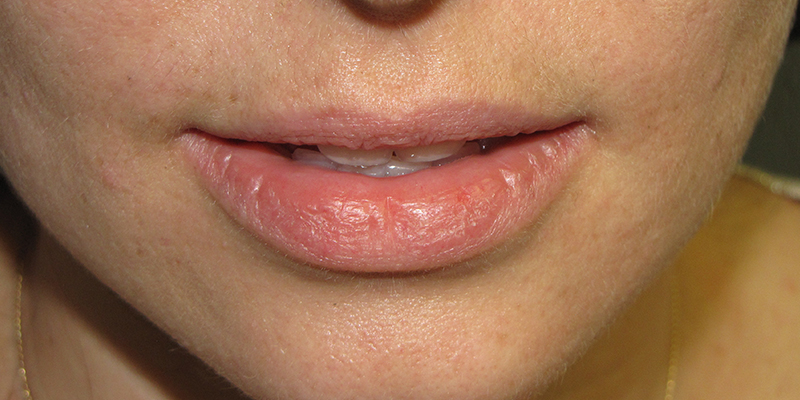 Actinic Cheilitis Treatment at Scars Center