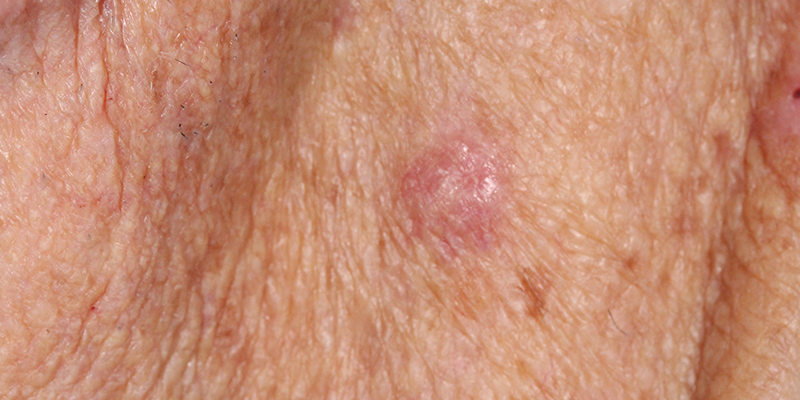 Atypical Fibroxanthoma Afx Skin Cancer And Reconstructive Surgery