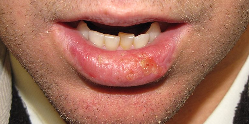 High-Risk-Squamous-Cell-Carcinoma-Lip-Skin-Cancer-and-Reconstructive-Surgery-Center-Orange-County