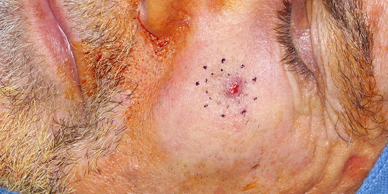 Invasive-Melanoma-Cheek-Skin-Cancer-and-Reconstructive-Surgery-Center-Orange-County