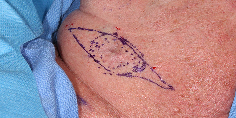 oral basal cell carcinoma