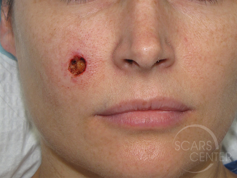 Skin-Cancer-And-Reconstructive-Surgery-Center-Skin-Cancer-Specialists-Intraoperative-Photos-WM-1