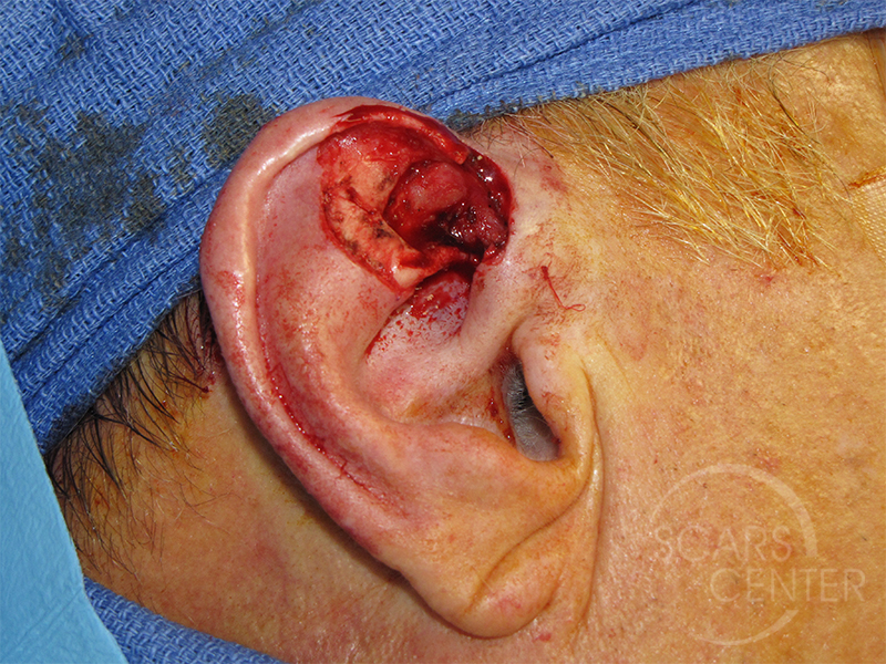 Skin-Cancer-And-Reconstructive-Surgery-Center-Skin-Cancer-Specialists-Intraoperative-Photos-WM-1