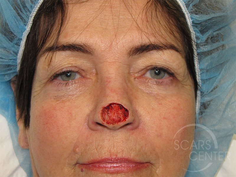 Nose Reconstruction 6 Skin Cancer And Reconstructive Surgery Center
