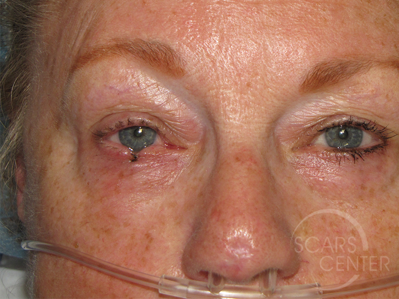 eyelid reconstruction surgery