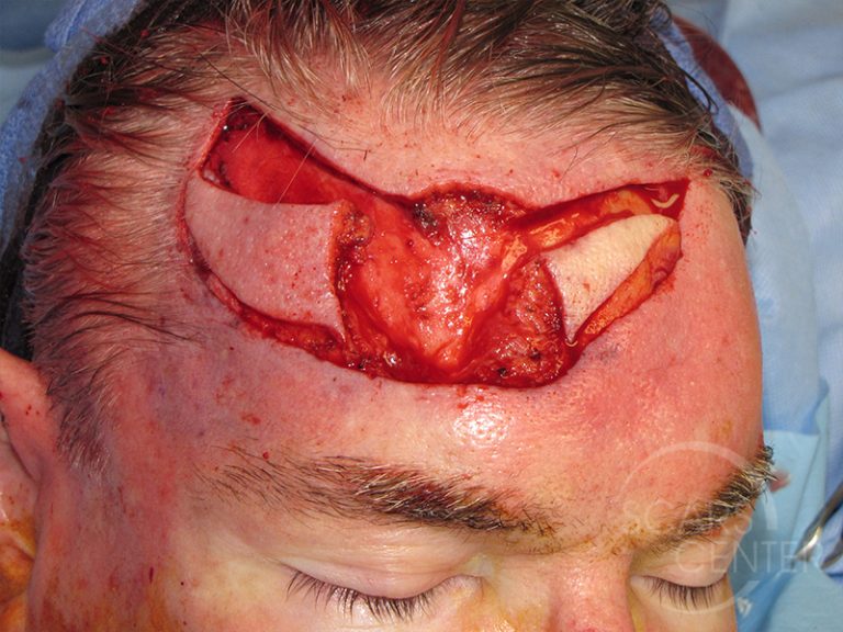 Forehead Reconstruction 1 - Skin Cancer and Reconstructive Surgery Center