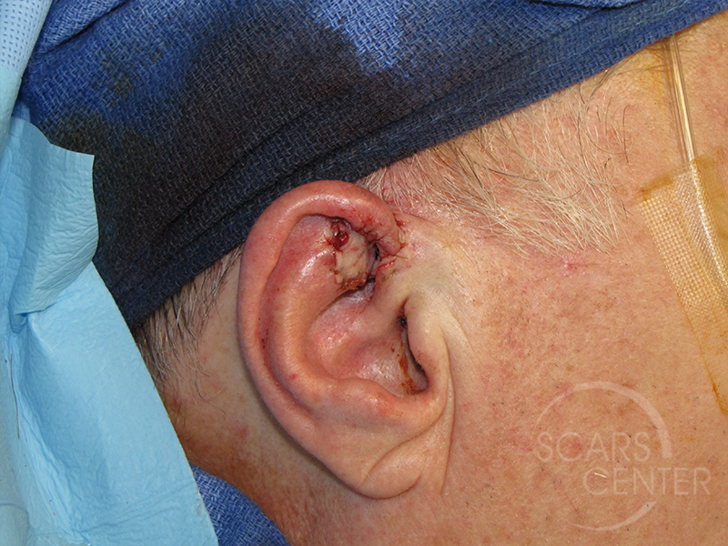 Skin-Cancer-And-Reconstructive-Surgery-Center-Skin-Cancer-Specialists-Intraoperative-Photos-WM-2