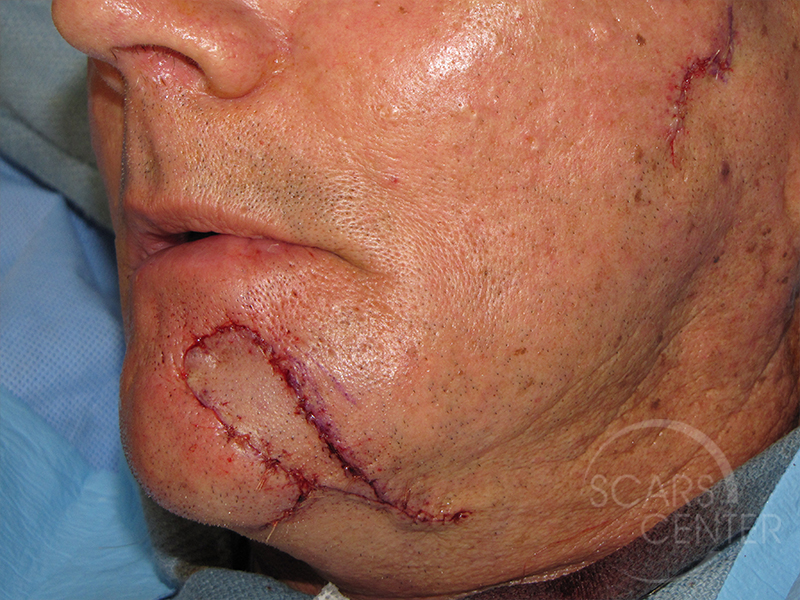 Skin-Cancer-And-Reconstructive-Surgery-Center-Skin-Cancer-Specialists-Intraoperative-Photos-WM-3