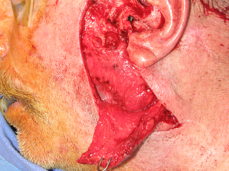 Skin-Cancer-And-Reconstructive-Surgery-Center-Skin-Cancer-Specialists-Intraoperative-Photos-WM-3