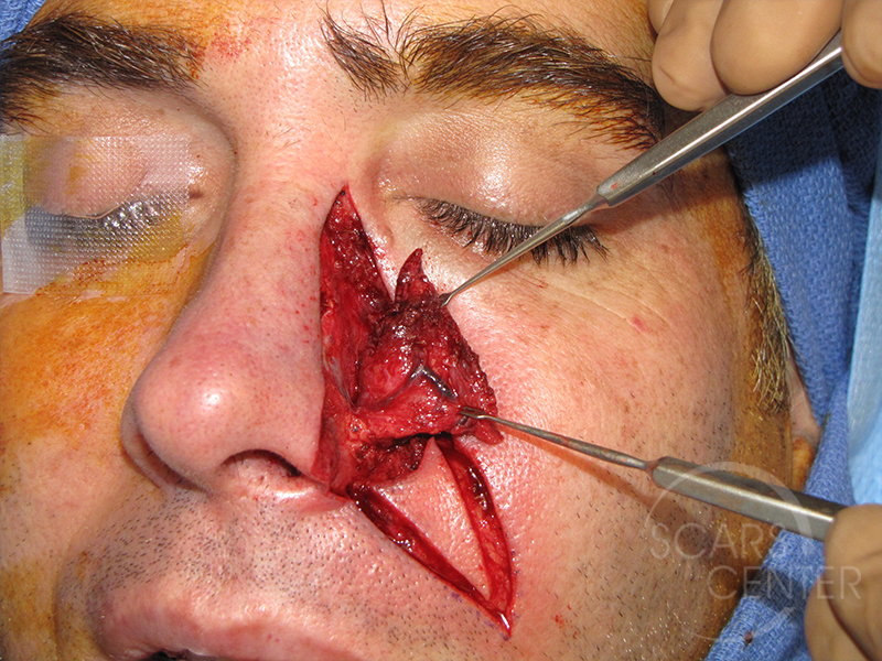Skin-Cancer-And-Reconstructive-Surgery-Center-Skin-Cancer-Specialists-Intraoperative-Photos-WM-4