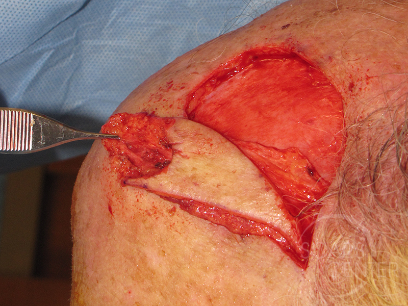 Skin-Cancer-And-Reconstructive-Surgery-Center-Skin-Cancer-Specialists-Intraoperative-Photos-WM-4