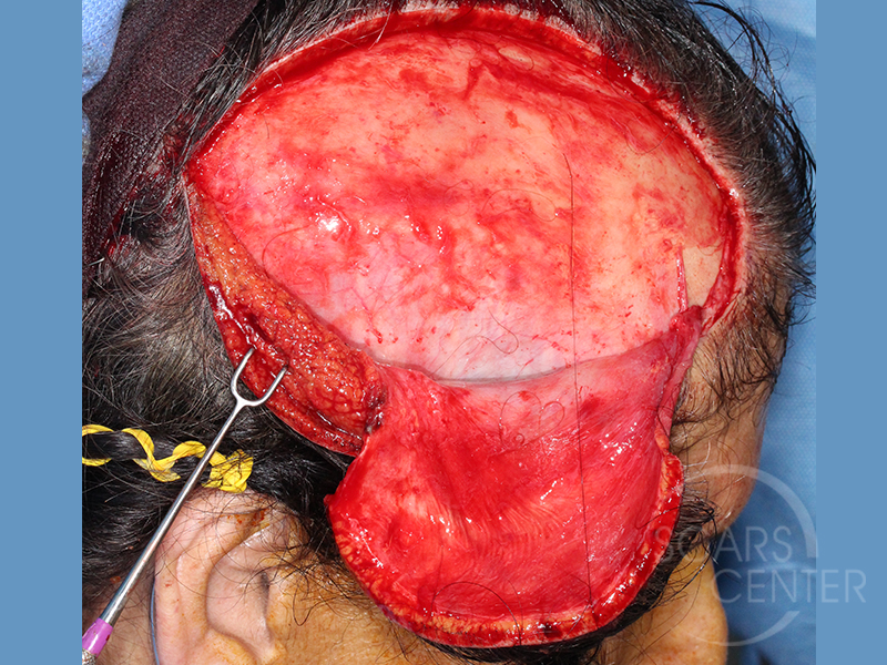 Skin-Cancer-And-Reconstructive-Surgery-Center-Skin-Cancer-Specialists-Intraoperative-Photos-WM-6