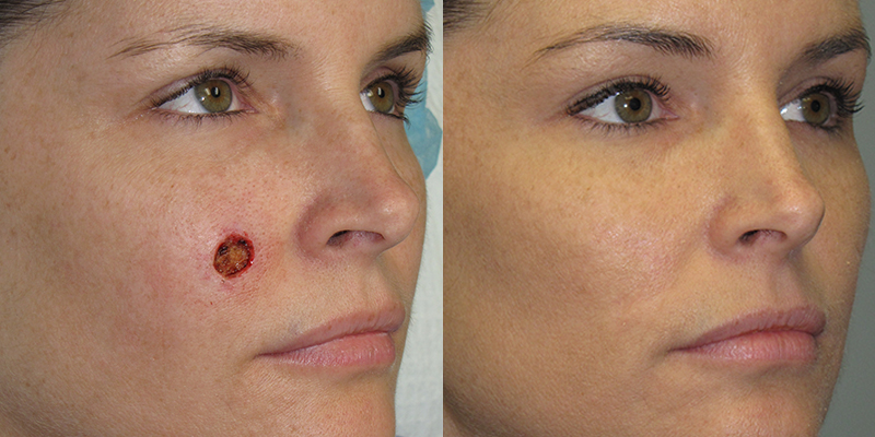 Cheek Reconstruction Skin Cancer And Reconstructive Surgery Center 