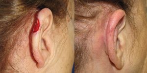 Skin-Cancer-And-Reconstructive-Surgery-Center-Skin-Cancer-Specialists-Reconstructive-Before-And-After-Ear-Cancer (12)
