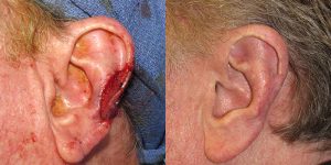 Skin-Cancer-And-Reconstructive-Surgery-Center-Skin-Cancer-Specialists-Reconstructive-Before-And-After-Ear-Cancer (13)