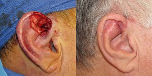 Skin-Cancer-And-Reconstructive-Surgery-Center-Skin-Cancer-Specialists-Reconstructive-Before-And-After-Ear-Cancer (14)