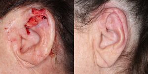 Skin-Cancer-And-Reconstructive-Surgery-Center-Skin-Cancer-Specialists-Reconstructive-Before-And-After-Ear-Cancer (15)
