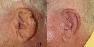 Skin-Cancer-And-Reconstructive-Surgery-Center-Skin-Cancer-Specialists-Reconstructive-Before-And-After-Ear-Cancer (16)
