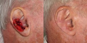 Skin-Cancer-And-Reconstructive-Surgery-Center-Skin-Cancer-Specialists-Reconstructive-Before-And-After-Ear-Cancer (9)