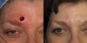 Skin-Cancer-And-Reconstructive-Surgery-Center-Skin-Cancer-Specialists-Reconstructive-Before-And-After-Forehead-Cancer (15)