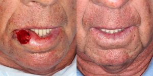 Skin-Cancer-And-Reconstructive-Surgery-Center-Skin-Cancer-Specialists-Reconstructive-Before-And-After-Forehead-Cancer (17)