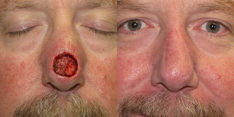 Skin cancer mose surgery