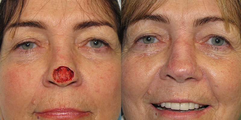 Nose Reconstruction Skin Cancer And Reconstructive Surgery Center