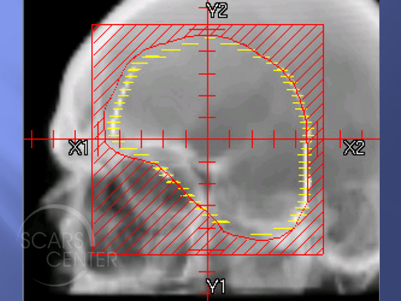 Radiation Therapy  Skin Cancer And Reconstructive Surgery Center