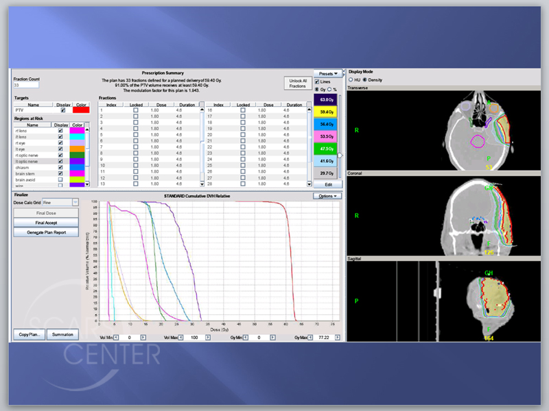 Skin-Cancer-And-Reconstructive-Surgery-Foundation-Forehead-SCC-with-perineural-invasion-IMRT-(Intensity-modulated radiation therapy)-Fields