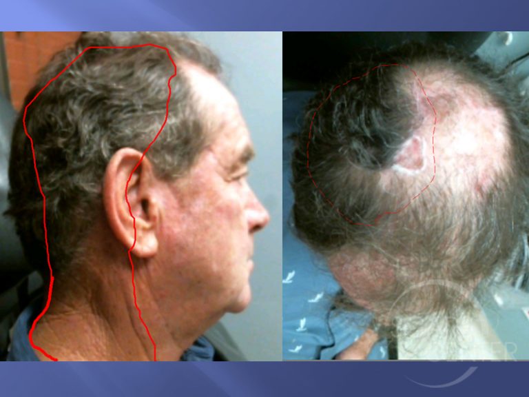 Scalp Scc Metastasis To Neck Skin Cancer And Reconstructive Surgery Center 