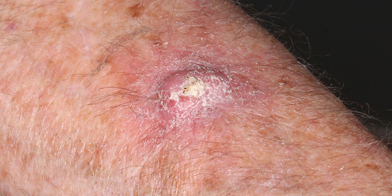 Skin-Cancer-Specialists-Squamous-Cell-Carcinoma-Keratoacanthoma-Skin-Cancer-And-Reconstructive-Surgey-Center-Orange-County