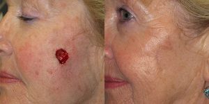 Squamous-Cell-Carcinoma-Cheek-Skin-Cancer-Reconstructive-Surgery-Center