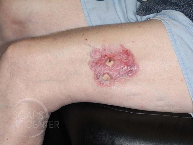 Skin-Cancer-And-Reconstructive-Surgery-Foundation-Large-BCC-of-Thigh-1