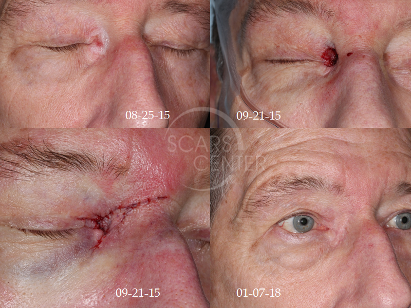 Skin-Cancer-And-Reconstructive-Surgery-Foundation-Patient-4-reconstructive-cases-medial-canthis-eyelid-reconstruction