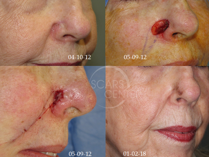 Skin-Cancer-And-Reconstructive-Surgery-Foundation-melanoma-with-recurrent-MIS1