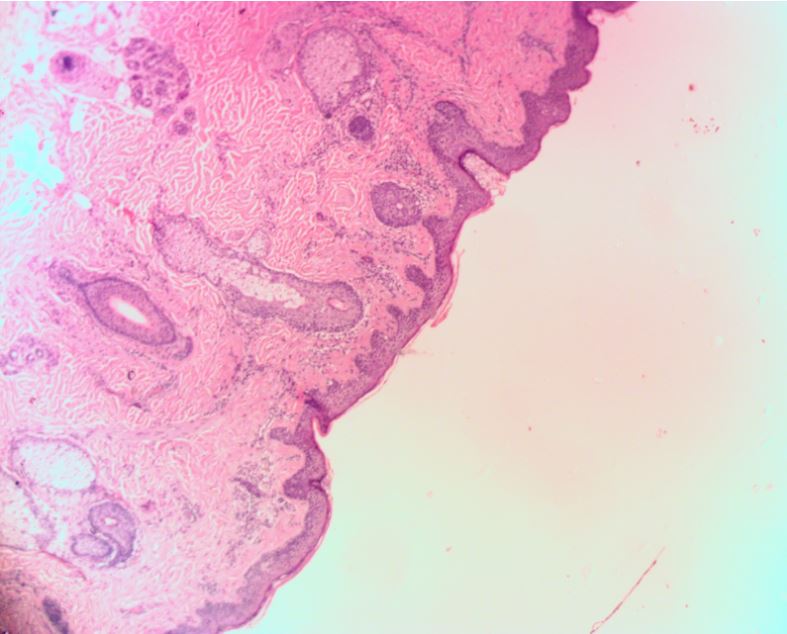Atypical-Spitzoid-Nevus-Histology-Orange-County-Skin-Cancer2