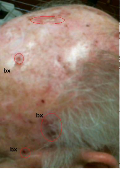 Treatment for Multiple Skin Cancer Patients